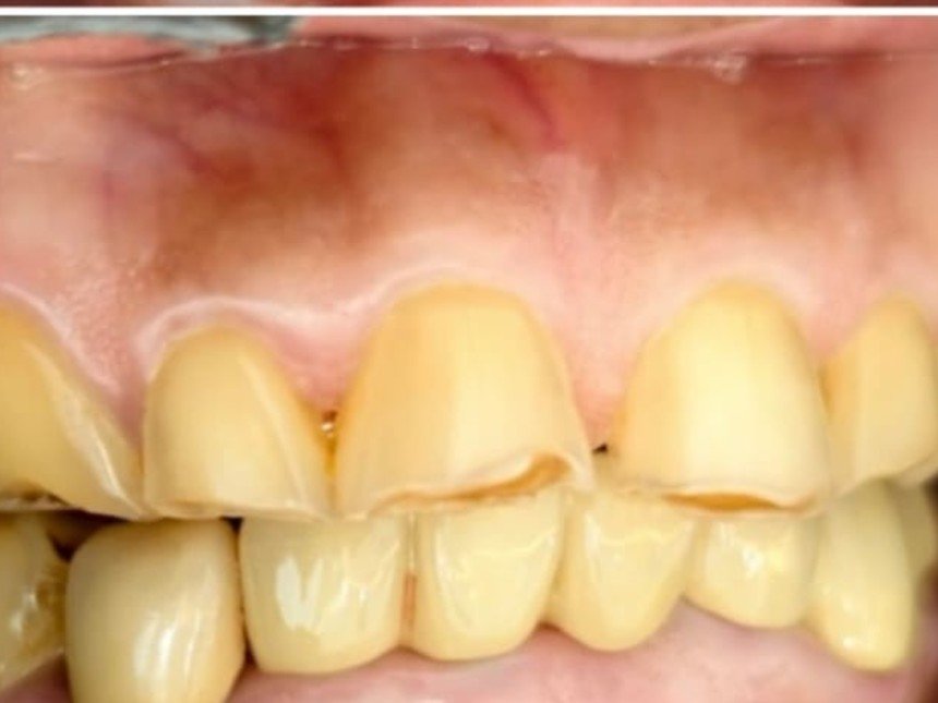 Case 2 after treatment at Dental Fit