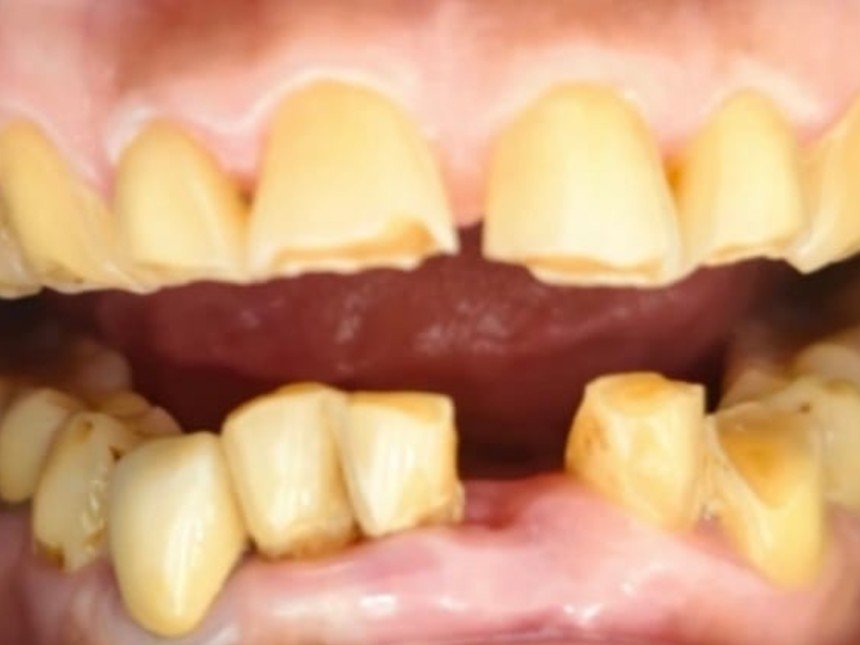 Case 2 before treatment at Dental Fit