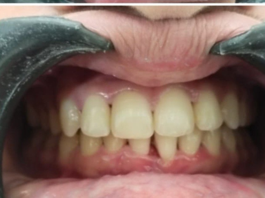 Case 3 after treatment at Dental Fit