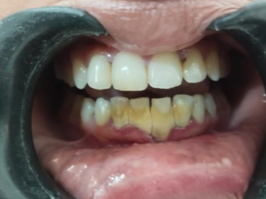 Case 3 before treatment at Dental Fit