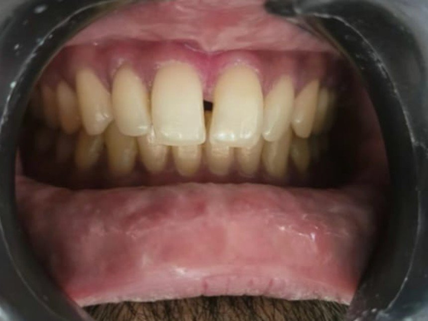 Case 4 before treatment at Dental Fit