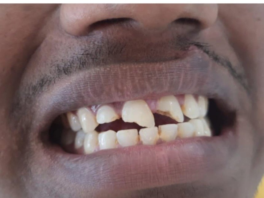 Case 1 before treatment at Dental Fit